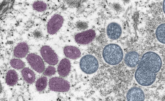 What you need to know about monkeypox on Vancouver Island - Vimarsana News